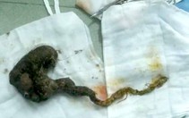Hội chứng “công chúa tóc mây”, nhổ tóc và... ăn tóc
