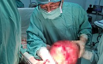 Phẫu thuật một phụ nữ u xơ tử cung hơn 5 kg