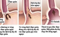 ​Trào ngược dạ dày thực quản: những điều cần biết