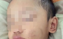 ​Điều tra nghi vấn bé trai 2 tuổi bị bạn trai của mẹ bạo hành