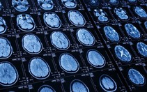 ​Phát hiện sớm chứng tự kỷ ở trẻ nhờ phương pháp chụp cắt lớp não