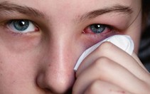 ​Bệnh viêm kết mạc cấp