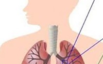 Bỏ thuốc lá để không gia nhập vào số 10 người chết/giây vì COPD!
