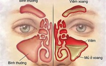 Vì sao bị viêm xoang mà lại thường xuyên buồn nôn?