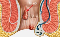 Bị trĩ, nên cắt hay điều trị thuốc Nam?