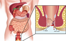 Đi cầu có máu, có phải bệnh trĩ?