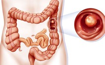 Polyp đại tràng có phát triển thành ung thư?