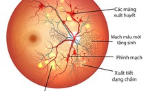 Bệnh võng mạc đái tháo đường - nguyên nhân chính gây mù lòa