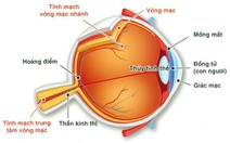 Bệnh lý tắc tĩnh mạch võng mạc gây mất thị lực