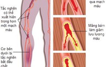 Tắc động mạch ngoại biên: âm thầm nhưng nguy hiểm