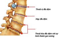 Thoái hóa cột sống ở người già và cách chữa