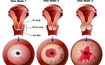 Sàng lọc phát hiện sớm ung thư cổ tử cung