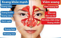 Viêm xoang cấp ở người lớn và cách phòng ngừa