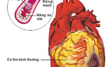 Cảnh giác đột quỵ não do tim khi giao mùa