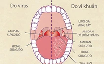 Bệnh viêm họng mùa lạnh