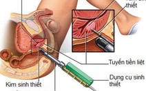 Ung thư tuyến tiền liệt