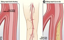 Bệnh động mạch ở chân - Những điều cần biết