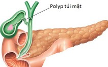 92% polyp túi mật có bản chất lành tính