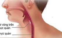 Nuốt khó là triệu chứng thường gặp của ung thư thực quản