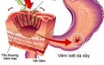 Vi khuẩn Helicobacter pylori gây loét dạ dày