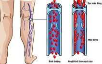 Những điều cần biết về bệnh huyết khối tĩnh mạch sâu