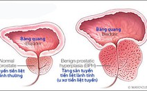 Những triệu chứng u xơ tiền liệt tuyến thường gặp