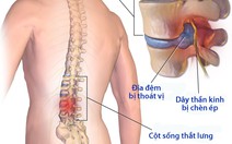 Điều trị thoát vị đĩa đệm