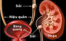 Sỏi đường tiểu