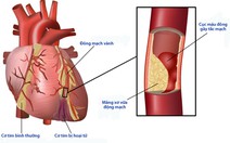 Biến chứng tim mạch của bệnh đái tháo đường