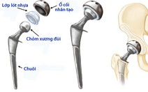 Thay khớp háng toàn phần