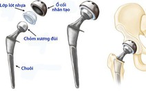 Thay khớp háng đường trước, có thể đi lại ngay hôm sau