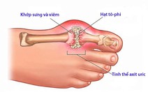 Chẩn đoán và điều trị bệnh gout