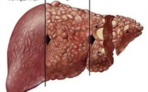 Viêm gan mạn tính tự miễn