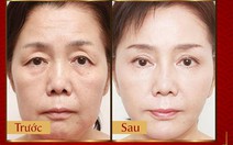 Phương pháp Laser Liposonic xóa nhăn, phục hồi da chảy xệ