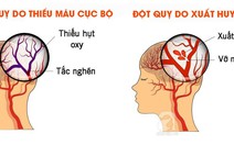 Chứng đột quỵ ở người cao tuổi