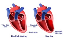 Bệnh suy tim