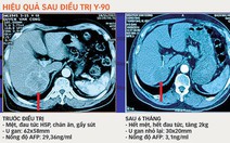 Thuốc ung thư Lipiodol tăng giá liên tục vì độc quyền