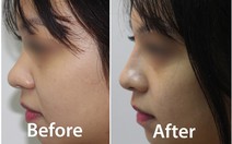 Những điều chị em nên biết khi làm đẹp bằng Filler