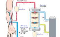 Nguy cơ chạy thận nhân tạo do ăn uống