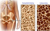 Tai biến do lạm dụng corticoid