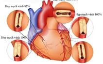 Hiểu biết về bệnh động mạch vành