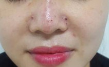 Tiêm filler nâng mũi, một phụ nữ bị biến chứng