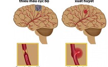 Đột quỵ não và khoảng “thời gian vàng” cho hồi phục