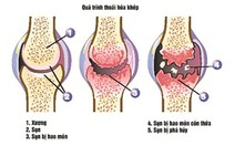 Ngừa thoái hóa khớp gối đúng cách