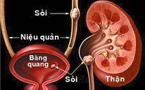 Phòng tránh bệnh sỏi tiết niệu