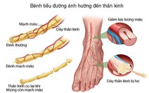 Bệnh thần kinh khu trú ở bệnh nhân đái tháo đường tuýp 2