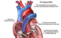 Các bệnh tim bẩm sinh thường gặp