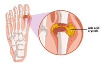 Hạt Cần tây trong Baigout – “vũ khí” chiến thắng bệnh Gout lâu năm