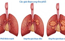 Điều trị ung thư phổi