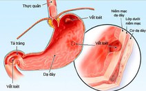 Những nguyên nhân hàng đầu gây bệnh sỏi thận